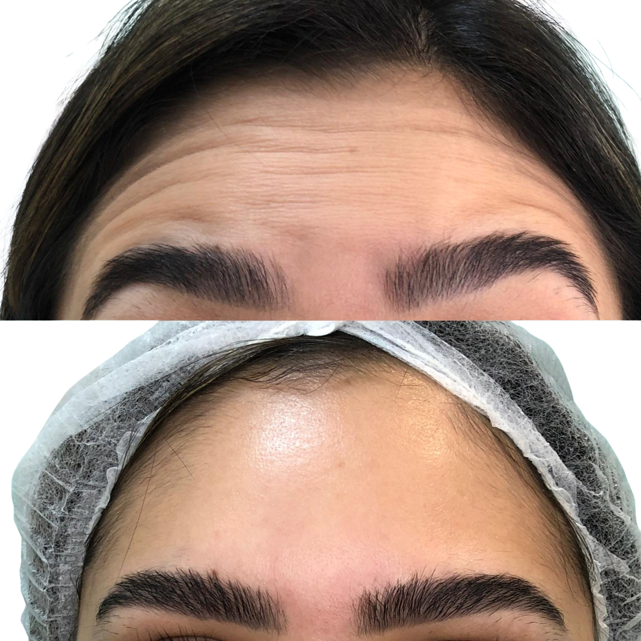 Botox Feminino